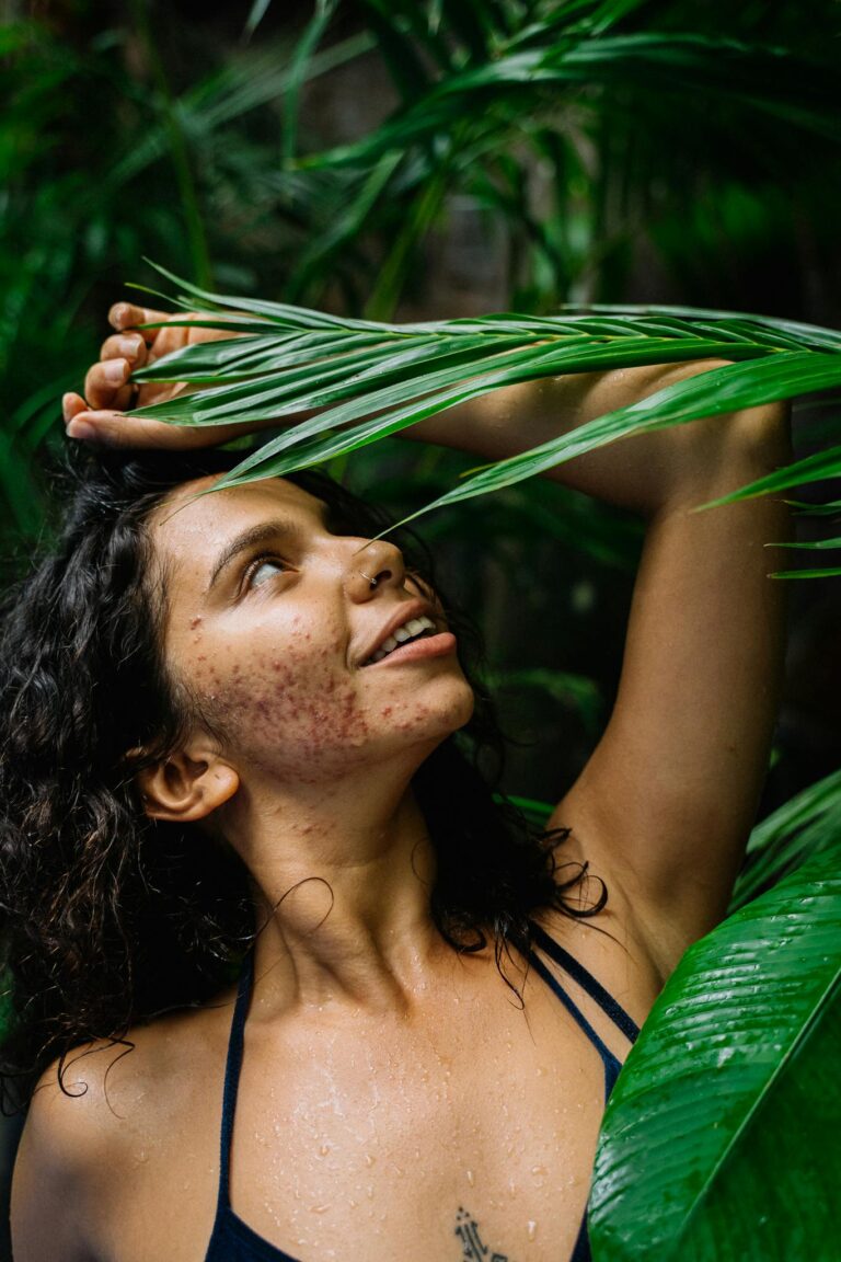A smiling woman with acne standing amidst lush green leaves, raising her hand outdoors.